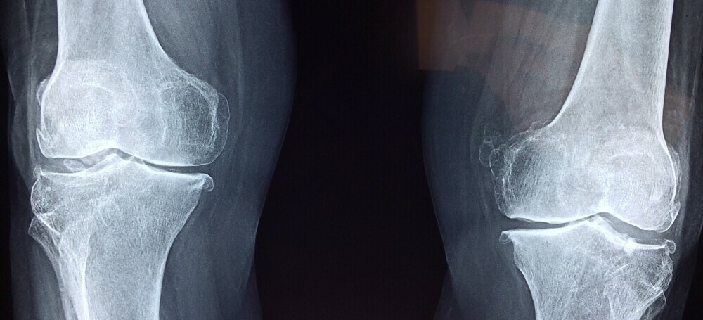 x-ray of joints